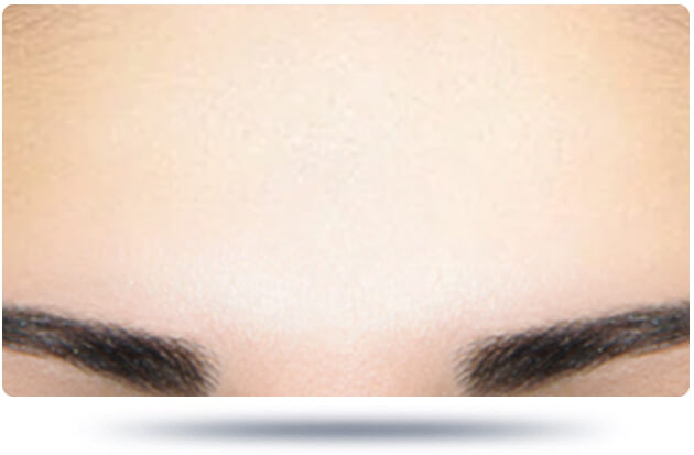 ازالة التجاعيد شد الوجه