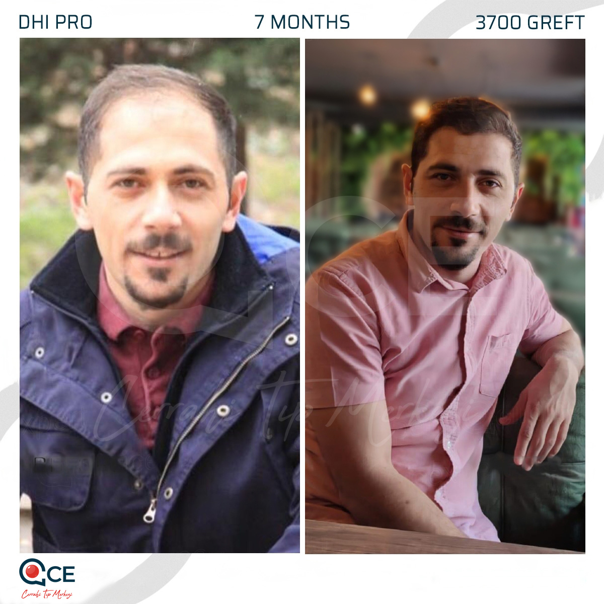 CE Tıp Merkezi Hair Transplant