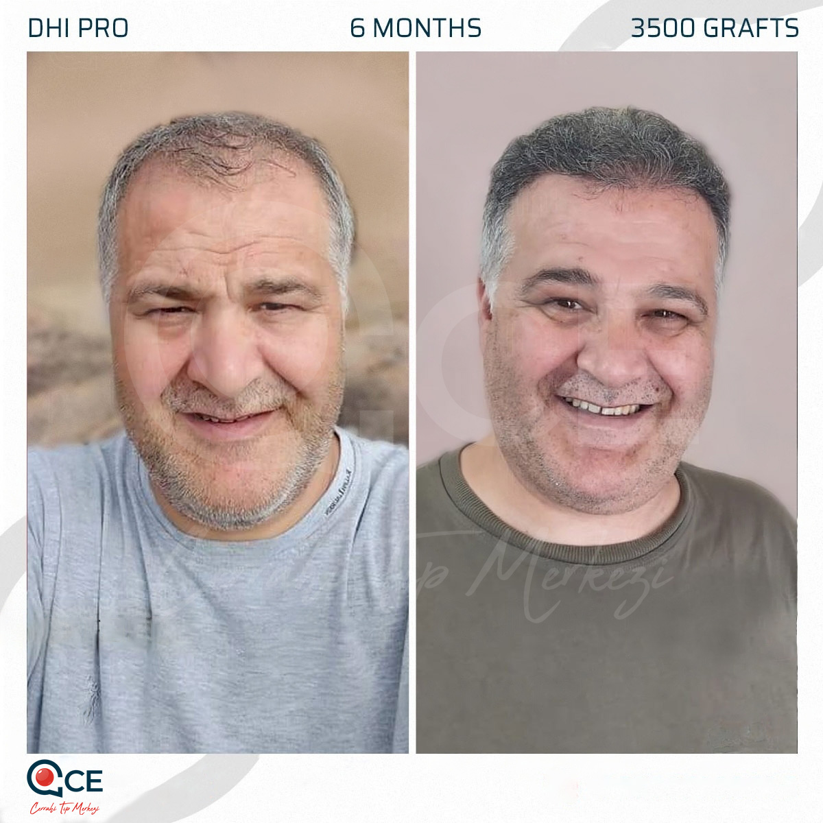 CE Tıp Merkezi Hair Transplant