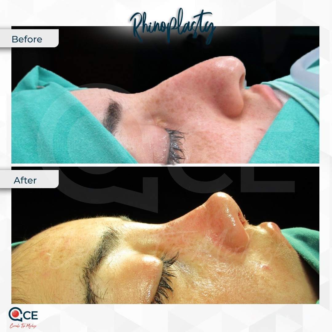 عملية تجميل الأنف