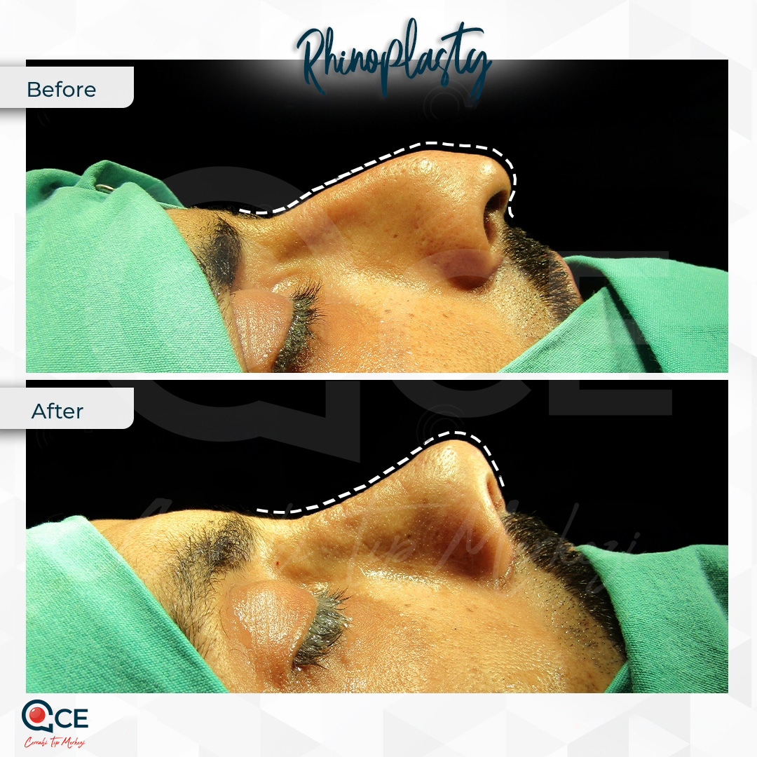 عملية تجميل الأنف