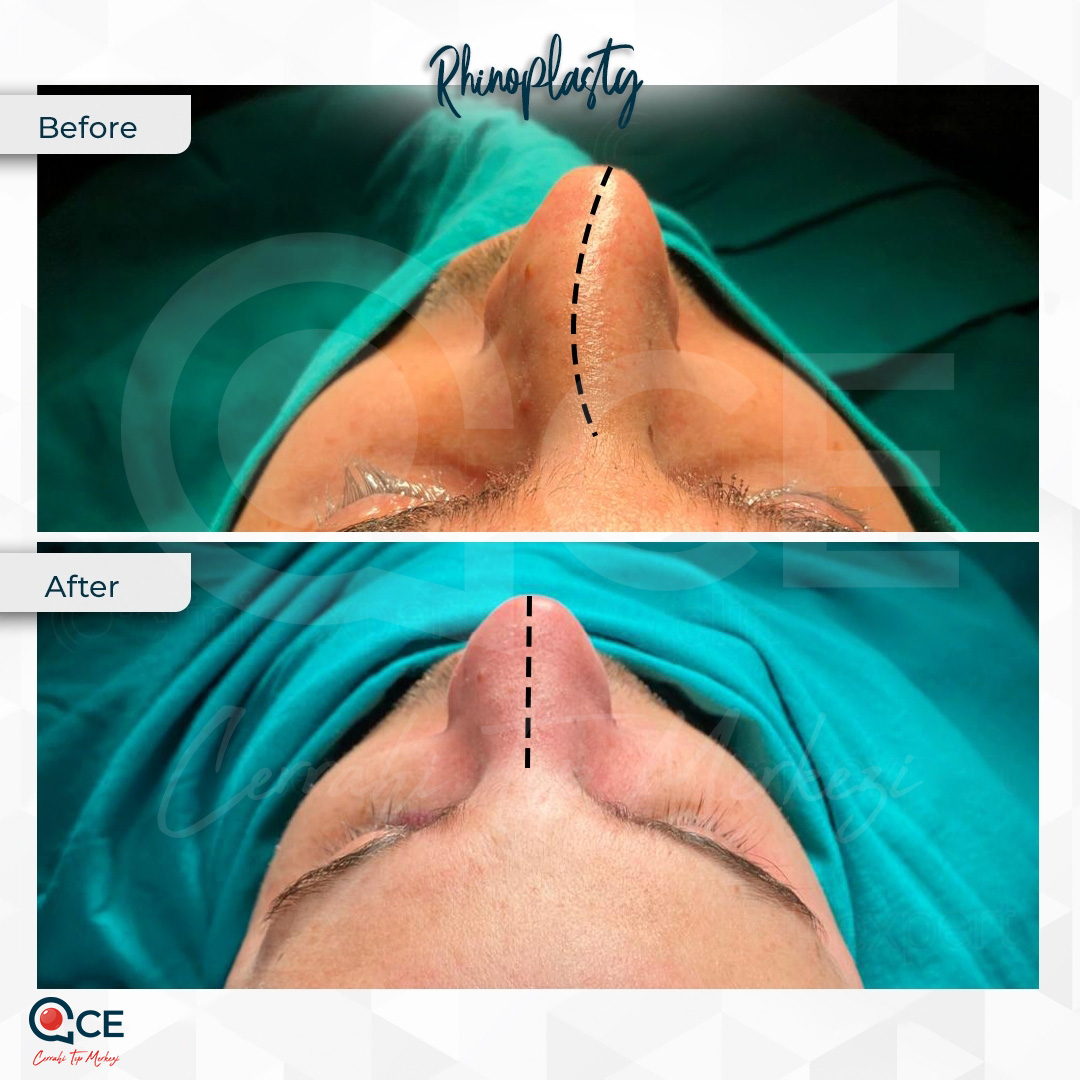 عملية تجميل الأنف
