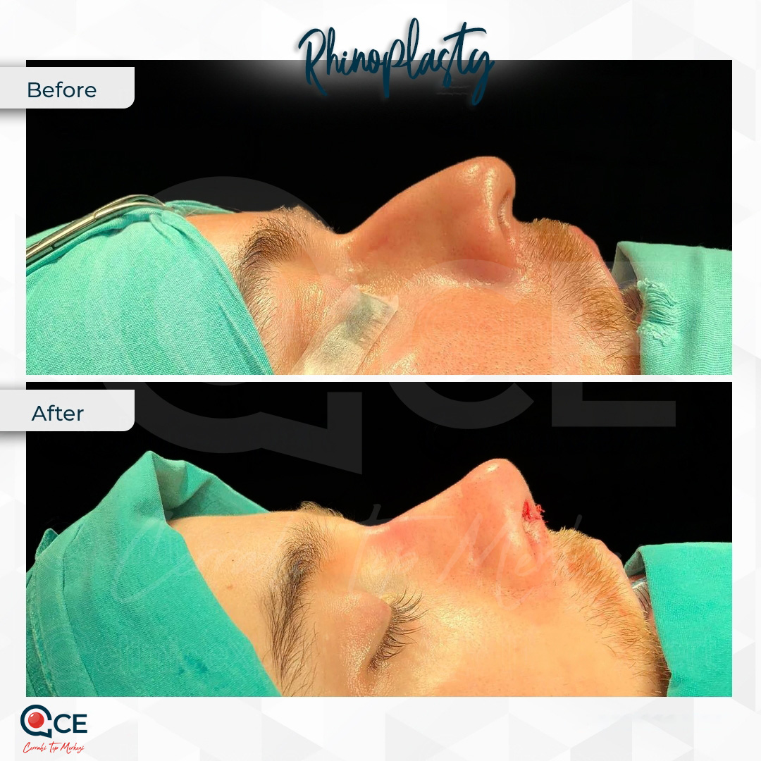 عملية تجميل الأنف