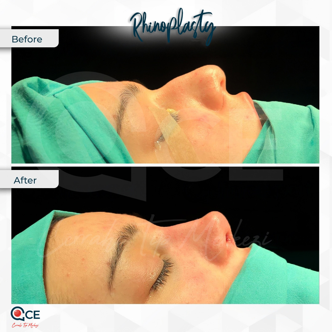 عملية تجميل الأنف