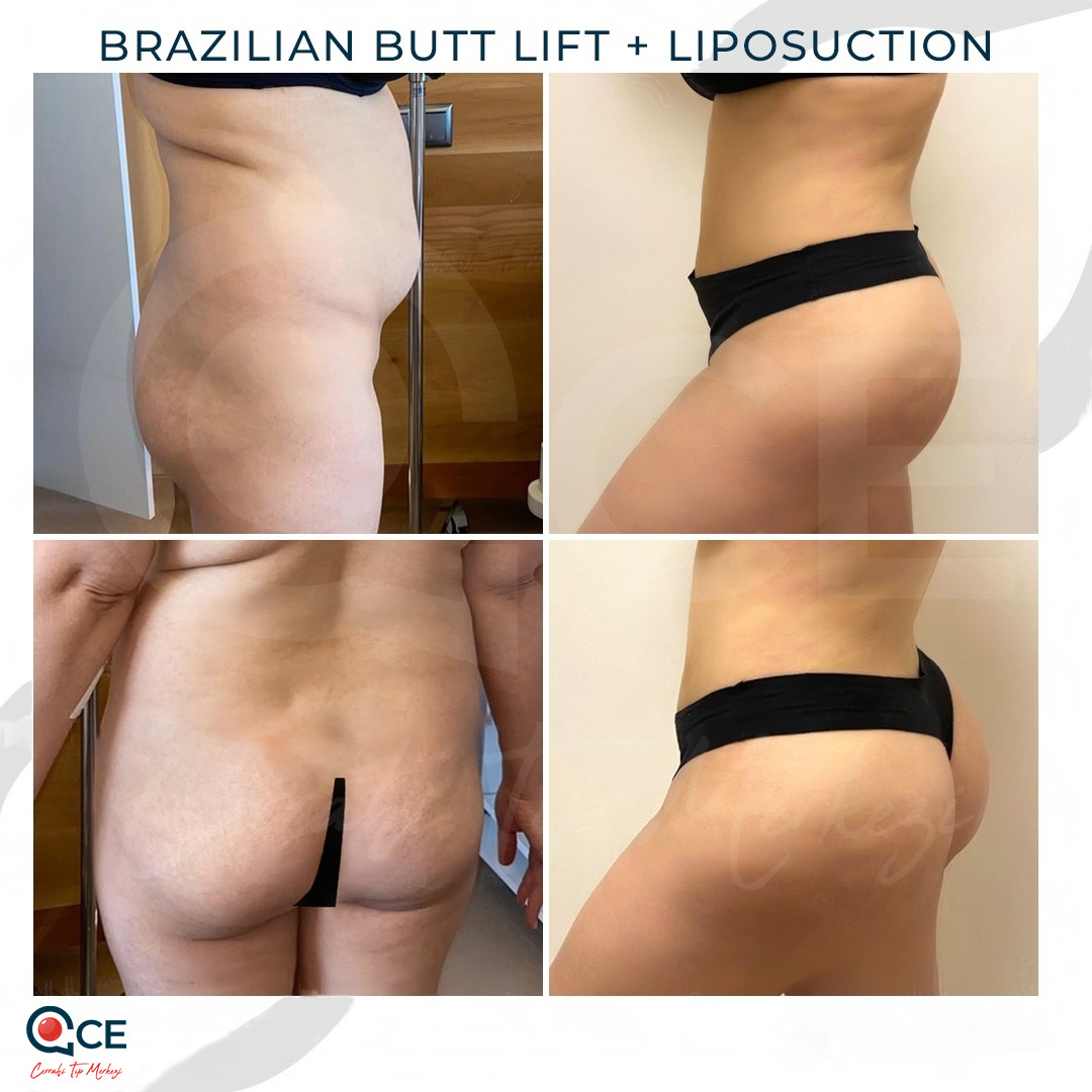 Rhinoplasty Rhinoplasty