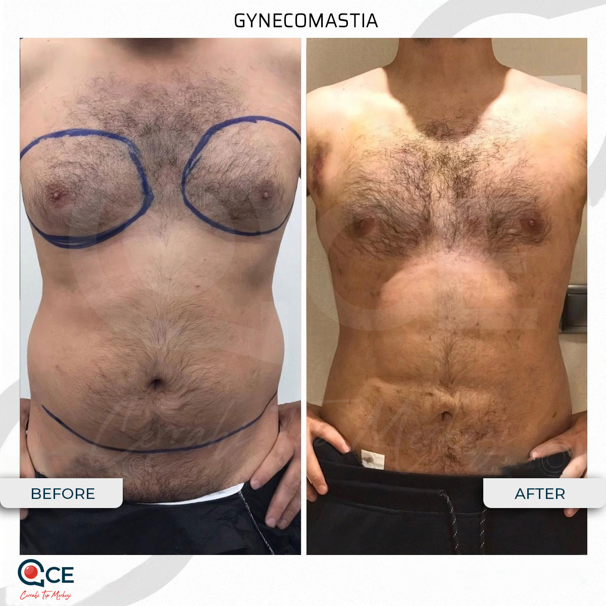 Breast Augmentation Breast Augmentation