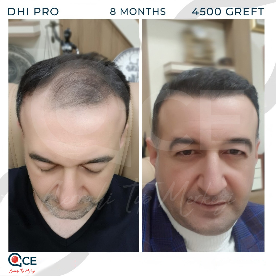 Hair Transplant