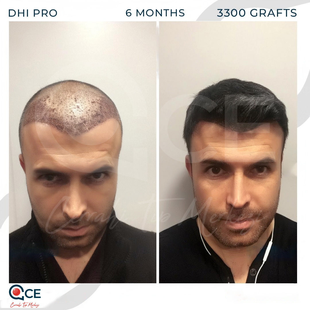 Hair Transplant