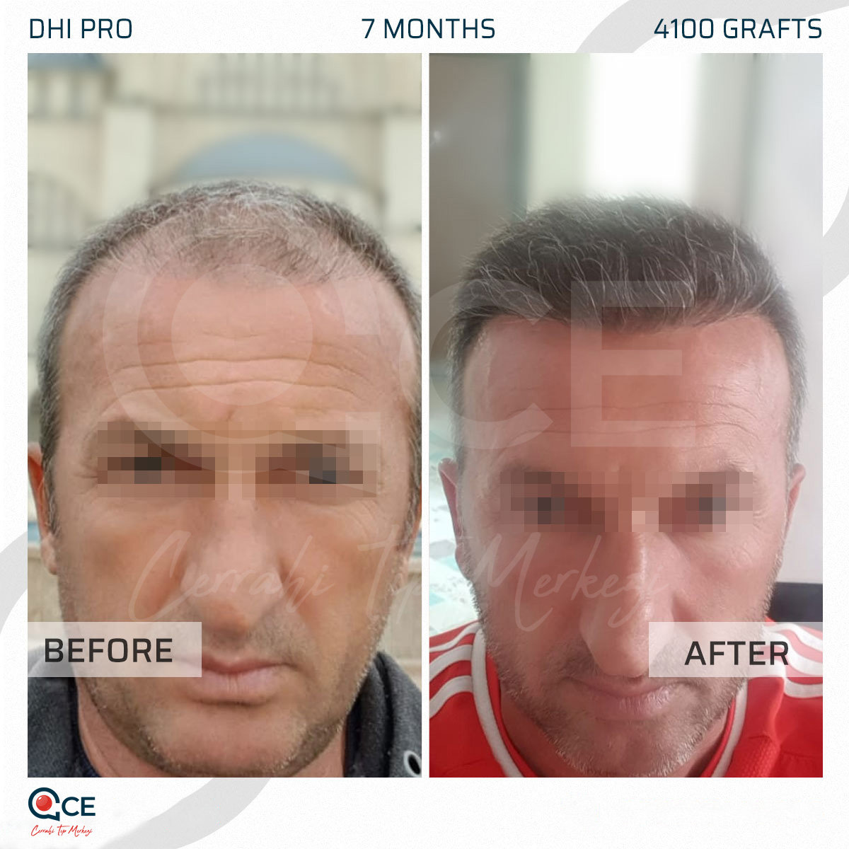 Implantation De Cheveux