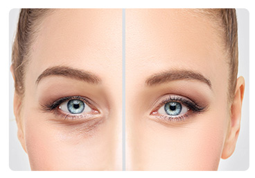 GÖZ KAPAĞI ESTETİĞİ